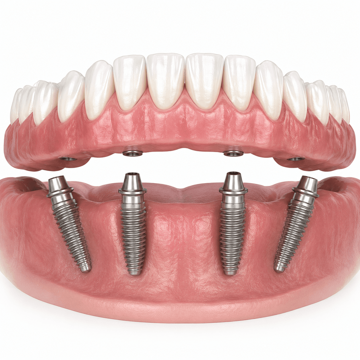 All-on-4 dental implant restoration illustration
