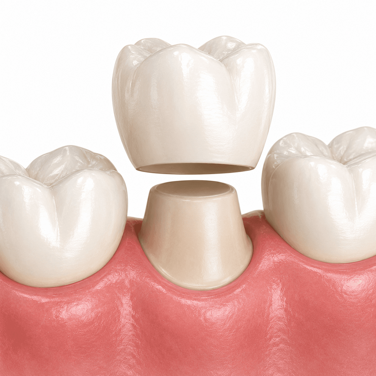 Dental crown placement on a prepared tooth